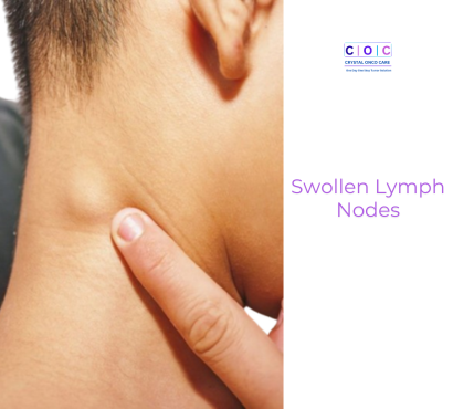 Swollen Lymph Nodes: When Neck Lumps Signal Cancer